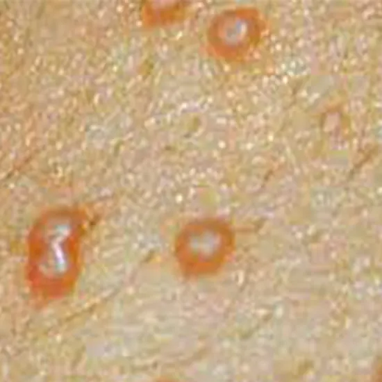 Small Bumps, Big Annoyance : Tackle Molluscum Contagiosum Virus Today